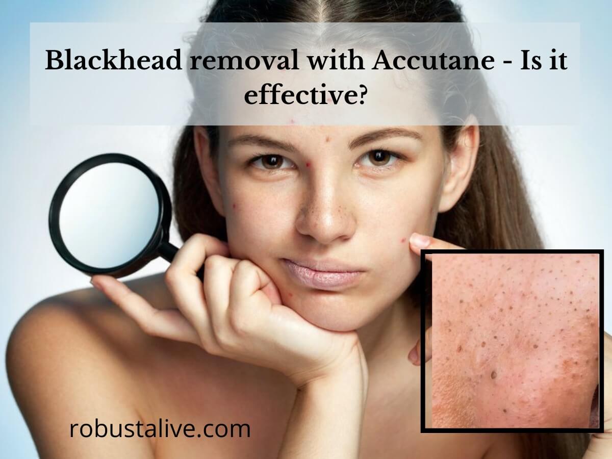 Blackhead removal with Accutane - Is it effective