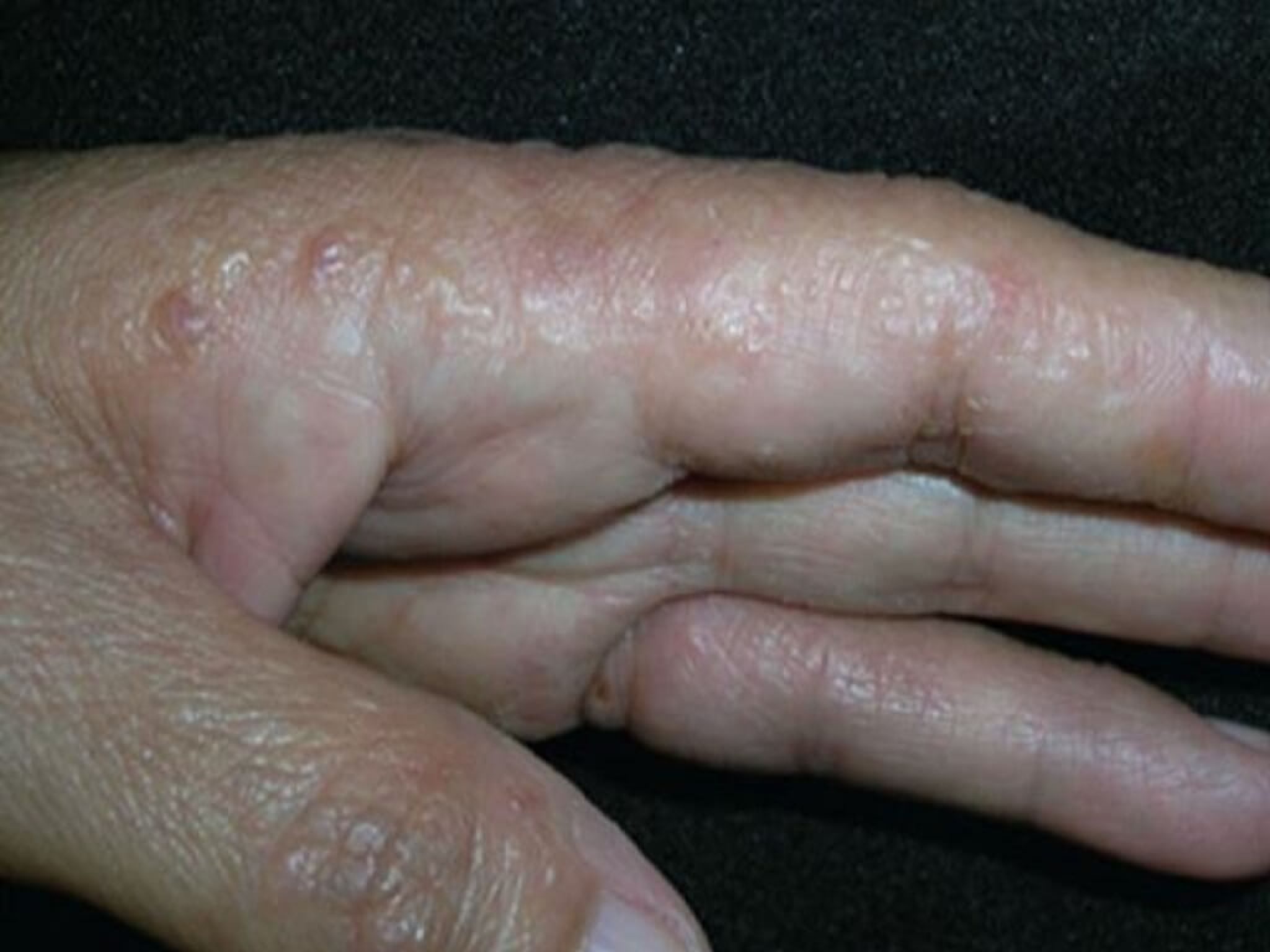 Skin Between Thumb and Index Finger What Causes Itching, Swelling