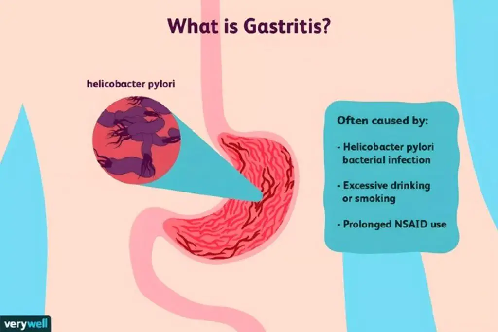 Is Potato Good For Gastritis? Robustalive