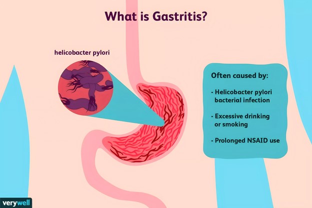 What is Gastric