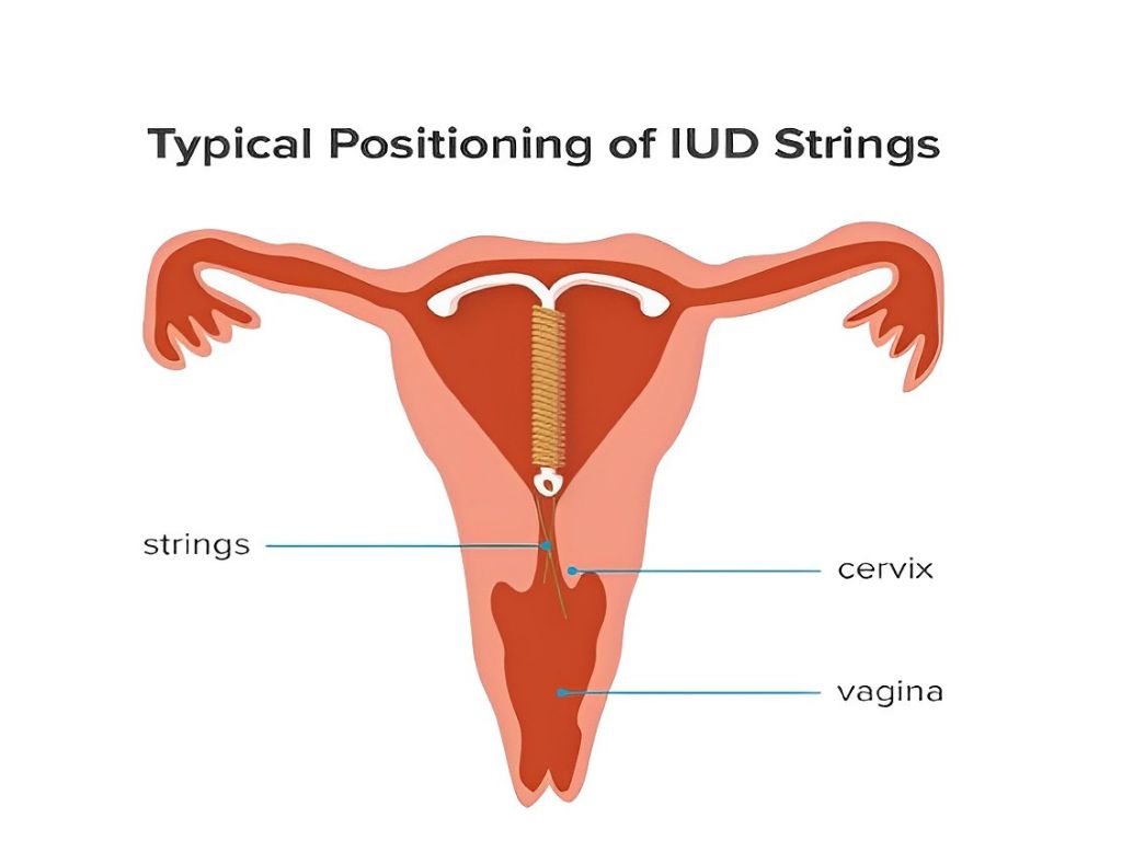 IUD Strings Longer During Period