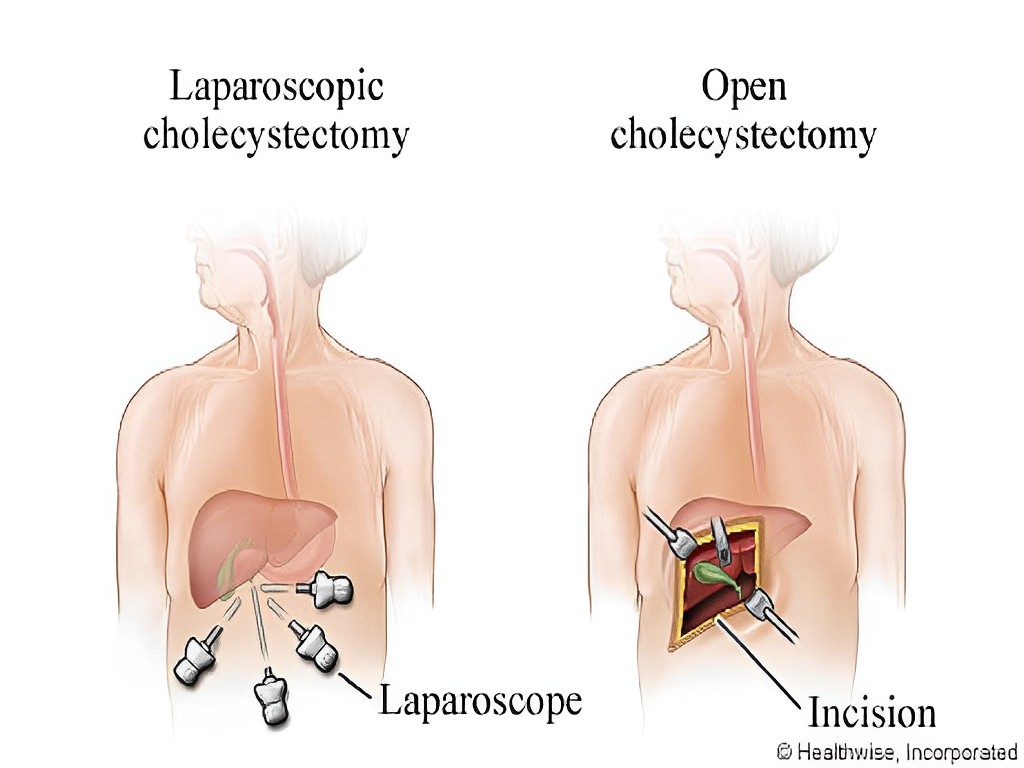 Types of Gallbladder Removal Surgeries