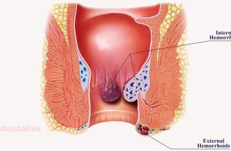 Can Clotrimazole and Betamethasone Dipropionate Cream Be Used for Hemorrhoids