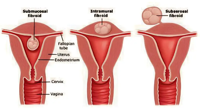 Size and location of fibroids