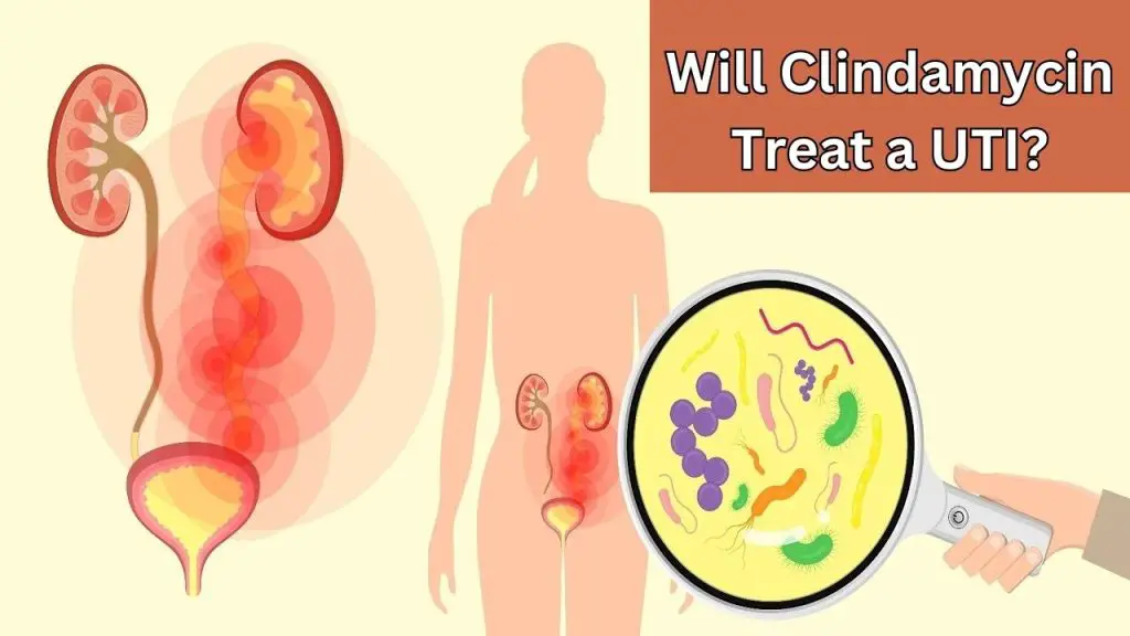 Will Clindamycin Treat a UTI? Find Out the Answers