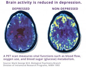 brain activity after taking TMS