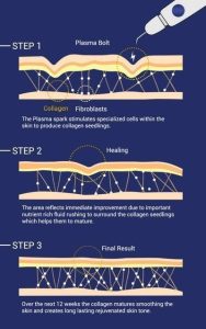 How Does Plasma Pen Fibroblast Work