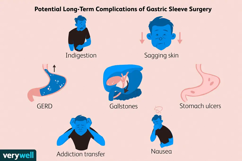 Who Should Not Go with Gastric Sleeve Surgery