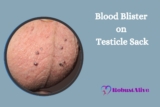 Blood Blister on Testicle Sack – Causes, Symptoms, and Treatment