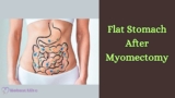 Achieving a Flat Stomach After Myomectomy