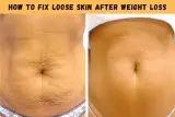 How To Fix Loose Skin After Weight Loss