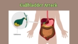 How To Stop A Gallbladder Attack While It Is Happening?