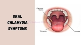 Oral Chlamydia Symptoms & Signs to Look Out For