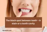 The black spot between teeth – A stain or a tooth cavity