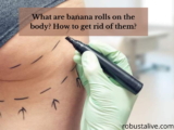 What are Banana Rolls on The Body? Best Tips for Getting Rid